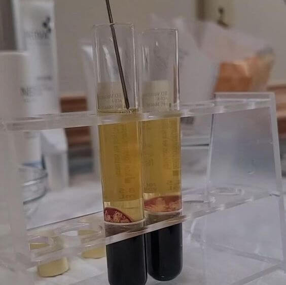 Close-up of two test tubes in a rack, each containing a clear yellow liquid above a dark-colored liquid, separated by a distinct interface that hints at the intricate balance crucial for optimal health. A thin needle is delicately inserted into one of the test tubes.