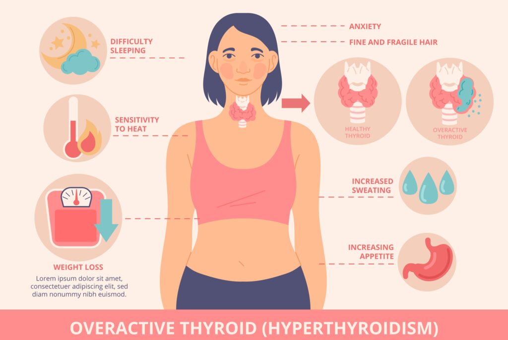 Illustration of a woman with symptoms of overactive thyroid, including difficulty sleeping, anxiety, fragile hair, heat sensitivity, sweating, weight loss, and increased appetite.