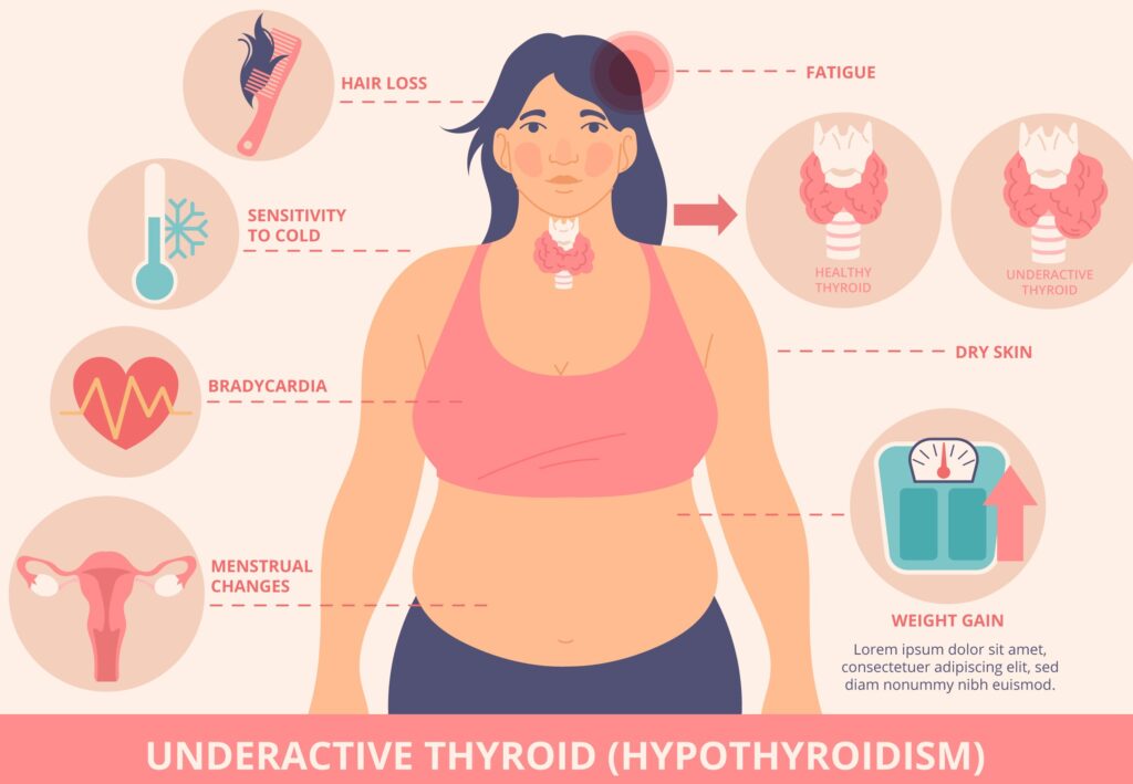 Infographic of hypothyroidism symptoms, including fatigue, hair loss, cold sensitivity, bradycardia, dry skin, menstrual changes, and weight gain, with thyroid gland illustrations.