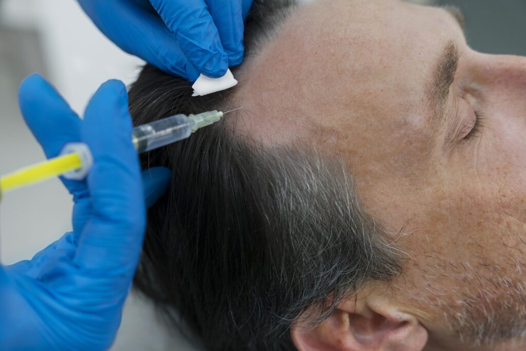 A person receives an injection in the scalp from a healthcare professional wearing blue gloves.